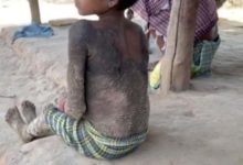 Фото - Маленькая девочка из Индии «превращается в камень» из-за редкой болезни