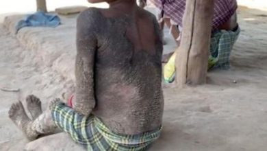 Фото - Маленькая девочка из Индии «превращается в камень» из-за редкой болезни