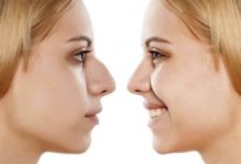 Фото - Хирурги научились изменять форму носа пациентам без операции