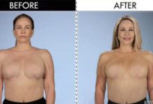 Фото - Пиявки помогли женщине избавиться от имплантатов в груди